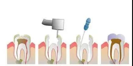很多患者往往会想要保留牙神经,但是有时候这样的期望并不能得到满足